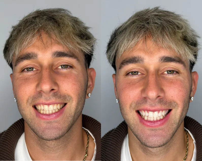 Caso antes y después